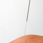 acupuncture Complete Wellness Physio