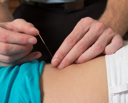 Dry Needling 3